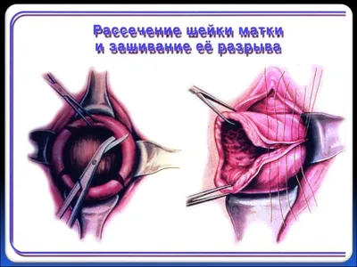 Что будет, если вовремя не снять швы — последствия после пластических  операций - Чемпионат