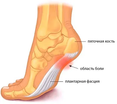 Лечение пяточной шпоры в Киеве - Vertebra