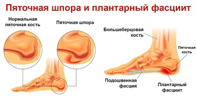 Ударно-волновая терапия при пяточной шпоре | Блог клиники Артромед