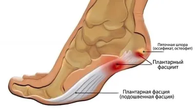 Пяточная шпора, лечение опытными специалистами в \"Эс клиник\". Избавим от  боли!