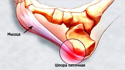 Больно наступать на пятку?» Пяточная шпора: причины, симптомы, лечение |  Жан Шоломицкий | Дзен