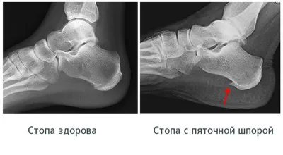 Центр Сыча С. Е. - КАК ИЗБАВИТЬСЯ ОТ ПЯТОЧНОЙ ШПОРЫ Шпора на пятке редко  развивается как первичная патология. Обычно разрастание пяточной кости  происходит на фоне основного заболевания, при котором появляется острый  отросток,