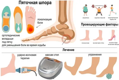 Пяточная шпора-что нужно знать | Пикабу