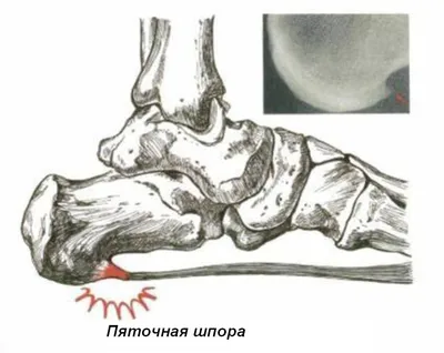 Лечение пяточной шпоры в Германии