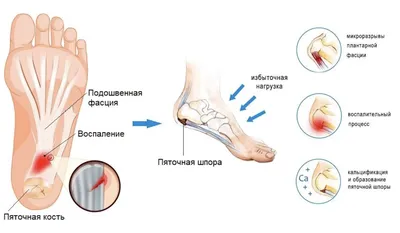 Пяточная шпора симптомы и лечение