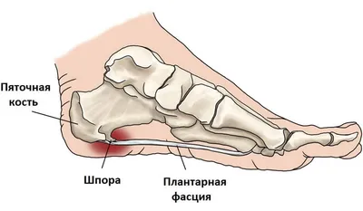 Лечение пяточной шпоры