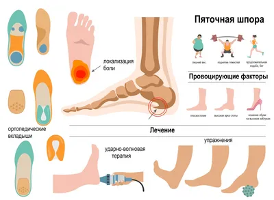 Пяточная шпора - причины появления, симптомы заболевания, диагностика и  способы лечения