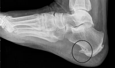 Calcaneal spur - Нейрохирургия Киев