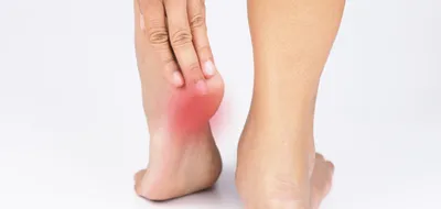 Calcaneal шпора Orthopedics Иллюстрация вектора - иллюстрации насчитывающей  ортопедия, микстура: 101719764