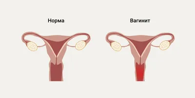 Потница у новорожденных: чем лечить грудничков и как избежать потницы?