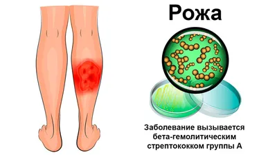 Потница у ребенка: причины, признаки, различия с аллергией и другими  высыпаниями - Дети - Babyblog