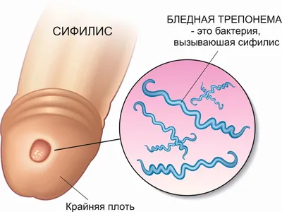 Инфекция ВИЧ