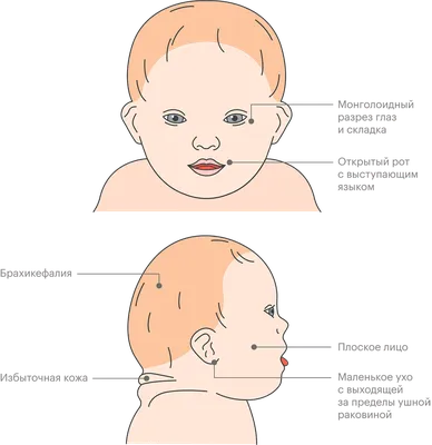 Что нужно знать о синдроме Дауна - Дом инвалидов