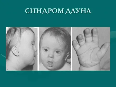 Синдром Дауна | Справка.Неинвалид.ru