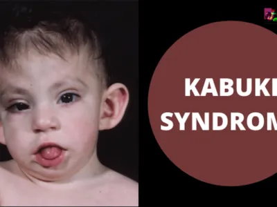 Kabuki Syndrome: What Is It, Causes, Signs, Symptoms, and More | Osmosis