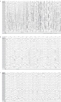 Clinical heterogeneity of Kabuki syndrome in a cohort of Italian patients  and review of the literature | European Journal of Pediatrics