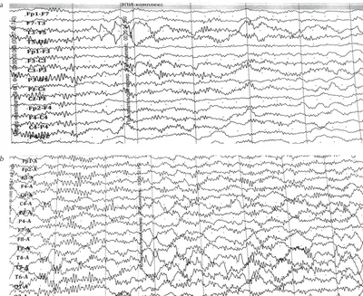 File:Kabuki syndrome 11.jpg - Wikipedia