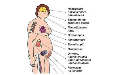 Синдром Иценко Кушинга: диагностика и цена на лечение