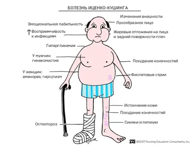 Синдром Иценко-Кушинга: лечение, диагностика, патогенез, симптомы,  рекомендации