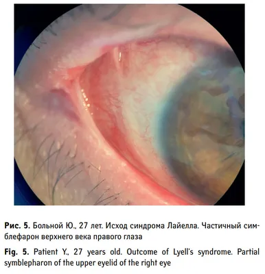 Toxic epidermal necrolysis (Lyell's syndrome) in a patient with HIV  infection - Popova - Epidemiology and Infectious Diseases