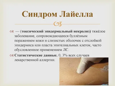 Синдром Лайелла - online presentation