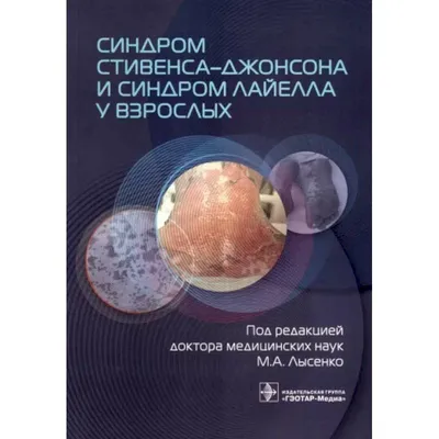 Рис. 4. Больной Ю., 27 лет. Исход синдрома Лайелла. «Географический» …