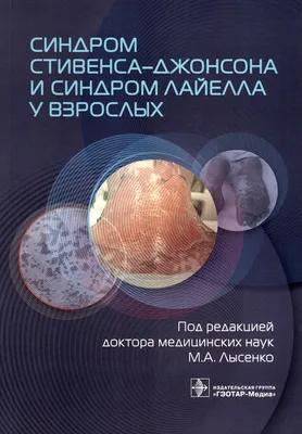 Синдром Лайелла: сложности диагностики – тема научной статьи по клинической  медицине читайте бесплатно текст научно-исследовательской работы в  электронной библиотеке КиберЛенинка