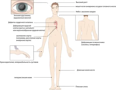 Image: Синдром Марфана (нарушения со стороны костно-мышечной системы) -  Справочник MSD Версия для потребителей