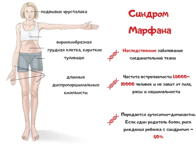 Синдром. Марфана синдром. + | Портал радиологов