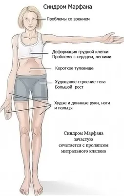 Болезнь Марфана: причины, признаки, лечение | О профилактике и лечении  заболеваний стоп | Дзен