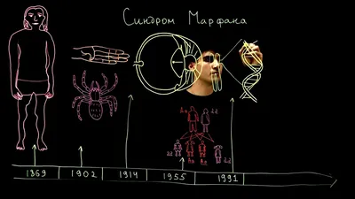 Рис. 12.2. Синдром Марфана: а) микрофакия, экватор хрусталика виден в …