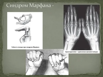 Синдром Марфана — болезнь гениев. | ДРАЙВ