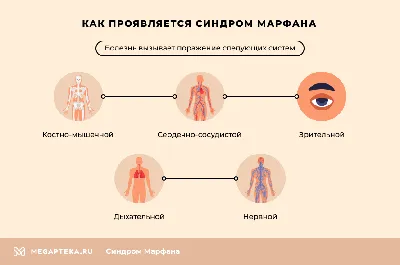 Лечение синдрома Марфана и клинические рекомендации