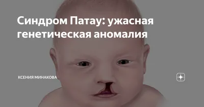 Синдром Эдвардса