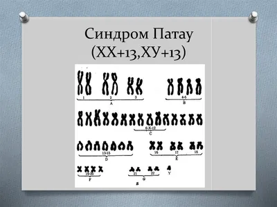 Синдром Патау (трисомия по 13-й хромосоме) - презентация онлайн