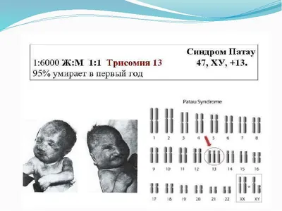 Sindrom Patau Edvardsa | PDF