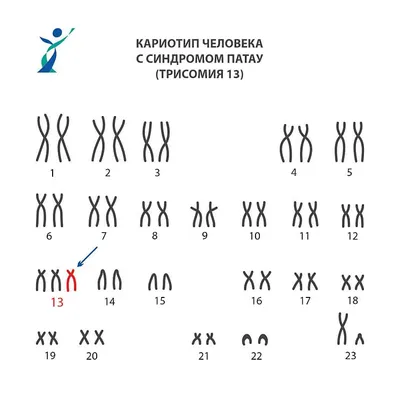 Синдром Патау