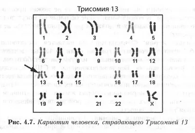 Синдром Патау - презентация, доклад, проект