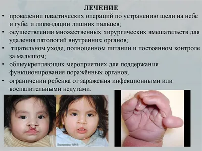 Синдром Патау Трисомия Кариотип Человека Мужчины стоковое фото ©AStepBioMed  649799874