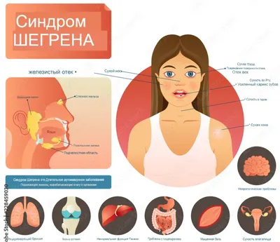 Сочетание саркоидоза легких и первичного синдрома Шегрена