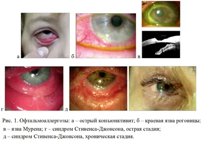 МЭЭ, синдром Стивенса-Джонсона, Синдром Лайелла - сходства и различия :-  Medznat