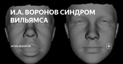 Синдром Вильямса: что нужно знать о редком заболевании и как обращаться с  особенными детьми | BURO.