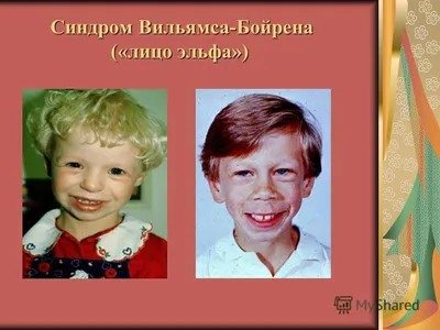 newrolog_guriya - СИНДРОМ ВИЛЬЯМСА @newrolog_guriya... | Facebook