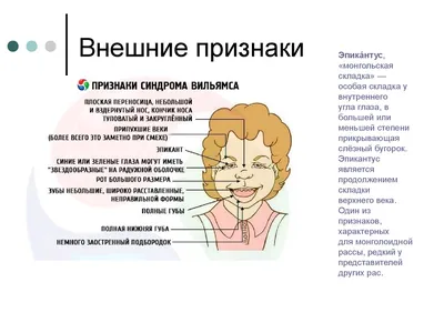 О случае ранней диагностики синдрома Вильямса у ребенка i года жизни – тема  научной статьи по клинической медицине читайте бесплатно текст  научно-исследовательской работы в электронной библиотеке КиберЛенинка