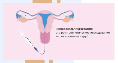 Спаечный процесс в малом тазу: лечение, диагностика в Москве в клинике  АльтраВита