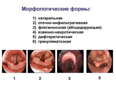 Синехии (сращение) малых половых губ у девочек ⠀ Иногда на прием к детскому  гинекологу приходят молодые мамочки с растерянным видом со словами «Доктор,  мне кажется, что у моей девочки что-то не так