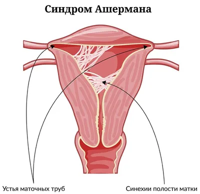 Синехии у девочек