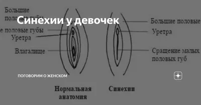 🟩🟧🟨 СИНЕХИИ У ДЕВОЧЕК Синехии - это сращение (слипание) малых половых  губ у девочек. Чаще всего бывает у младенцев и девочек раннего… | Instagram