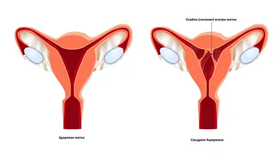 Синехии у девочек | Поговорим о Женском | Дзен