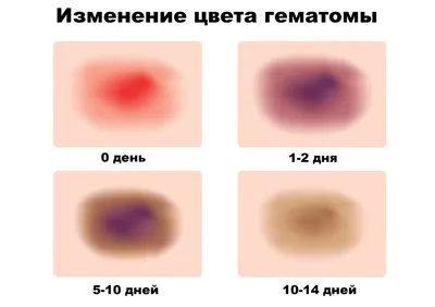 Врач-флеболог объяснил, почему на теле неожиданно появляются синяки |  bobruisk.ru